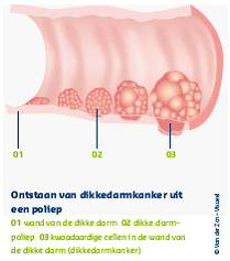darmkanker
